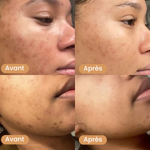 Masque au collagène - Anti taches, bouton, visage gras (PROMO FÊTE DES MÈRES  - Stock presqu'épuisé)